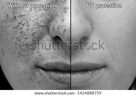 Ultraviolet photograph of the face exposed to the sun's rays wit
