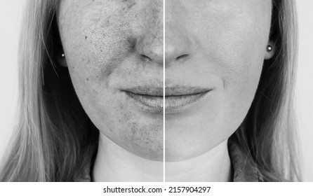 Ultraviolet Rays On Skin. Protective Creams Test. On The Left, The Skin Is Unprotected And Stains From UV Exposure Are Visible On It. On Right, Skin Is Clean Under The Protection Of Special Products.