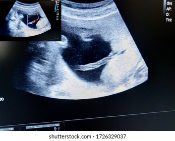 Umbilical Cord By Ultrasound Scan Stock Photo 1726329037 | Shutterstock