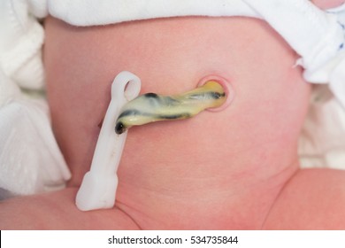 Umbilical cord cut and clamped right after birth of the newborn baby but still attached to the navel