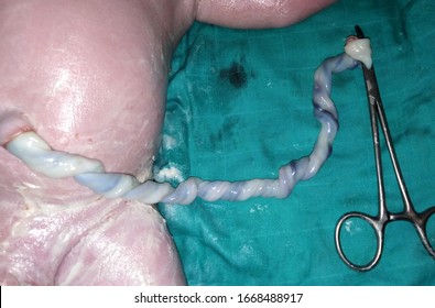 Umbilical Cord Of A Newborn Baby Clamp With Kocher Pliers After Birth