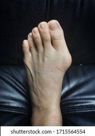 Unaligned Big Toe With Bunion