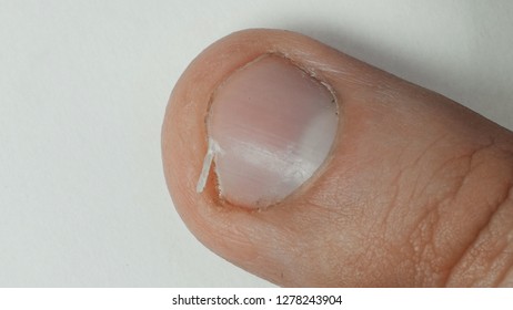 Unattended And Broken Nail, Cracked Skin, Bad Nail Grooming