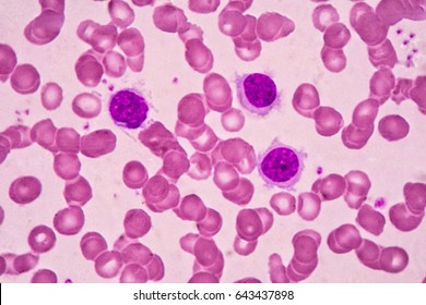 Under Microscopy, Hairy Cell Leukemia, A Rare, Slow-growing Cancer Of The Blood.