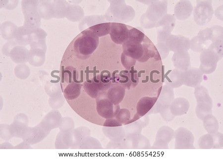 Under microscopy showing Information on the blood parasites of the genus Plasmodium.  Plasmodium falciparum is a protozoan parasite, one of the species of Plasmodium that cause malaria in humans.