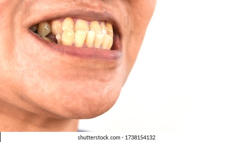 Underbite Dental Occlusion ( Malocclusion Of Teeth ) Problem Teeth.