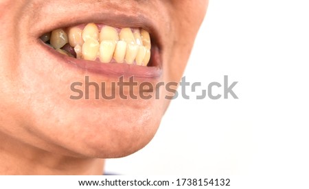 Underbite dental occlusion ( Malocclusion of teeth ) Problem teeth.