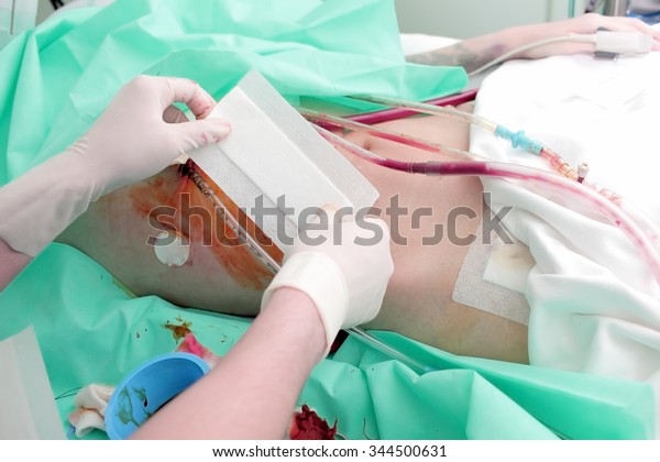 Underground kidney\
transplant surgery\
concept