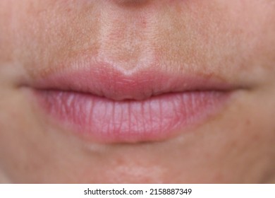 Uneddited Causasian Woman With Melasma Above Mouth, Sun Induced Pigmentation, Dermatology. 