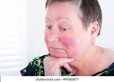 209 Rosacea nose Images, Stock Photos & Vectors | Shutterstock