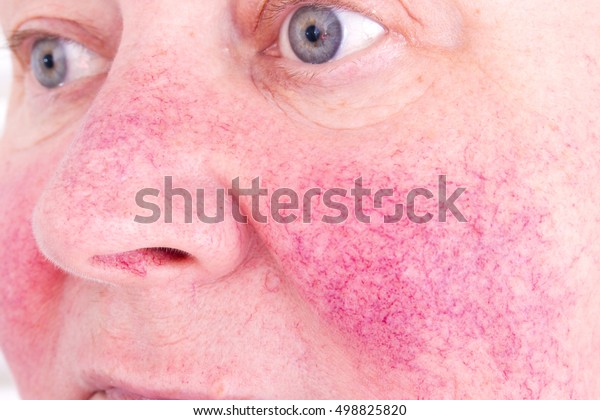 Unhappy elderly woman with skin condition rosacea\
characterized by facial redness, small and superficial dilated\
blood vessels, no\
make-up