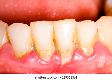 Unhealthy Denture, Tartar On Frontal Teeth, Plaque And Gingivitis