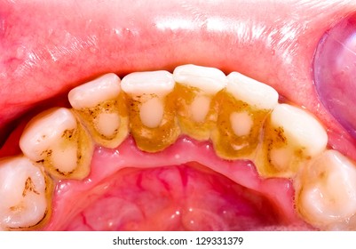 Unhealthy Denture, Tartar On Frontal Teeth