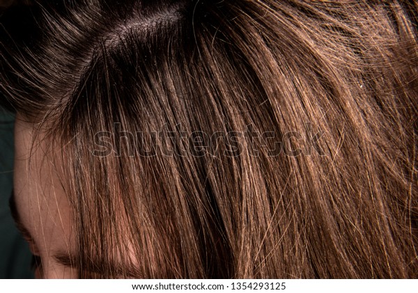 Unhealthy Head Skin Problem Hair Loss Stock Photo Edit Now