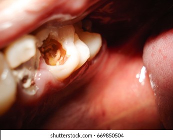 unhealthy tooth with dental caries and cavity formation with worms, within mouth.