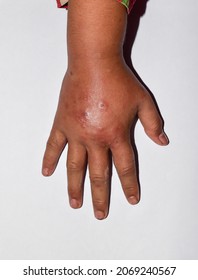 Unilateral Edema With Scabies Of Upper Limb. Swollen Hand And Arm Of Asian Child.