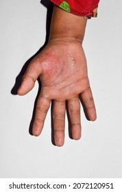 Unilateral Edema With Scabies Of Upper Limb. Swollen Hand And Arm Of Asian Child.