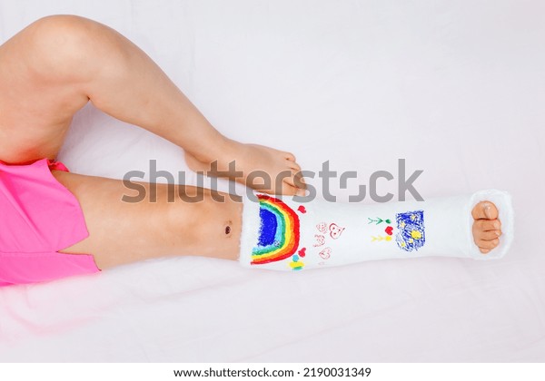 An\
unrecognizable little girl with a broken leg at home on the bed\
drew with felt-tip pens on an orthopedic cast. How to have fun with\
a broken leg. Broken leg in a cast in a small\
child.