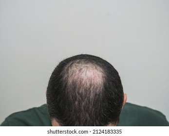 Unrecognizable man with hair loss problem
