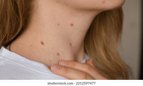 Unrecognizable Woman Showing Her Birthmarks On Neck Skin Close Up Detail Of The Bare Skin Sun Exposure Effect On Skin, Health Effects Of UV Radiation Woman With Birthmarks Pigmentation