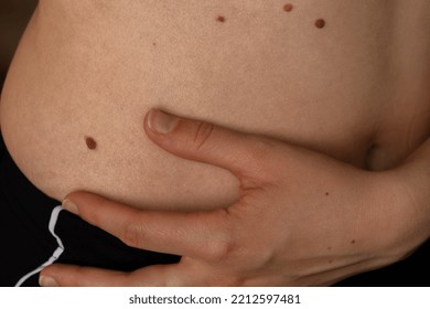 Unrecognizable Woman Showing Her Birthmarks On Skin Close Up Detail Of The Bare Skin Sun Exposure Effect On Skin, Health Effects Of UV Radiation Woman With Birthmarks Pigmentation