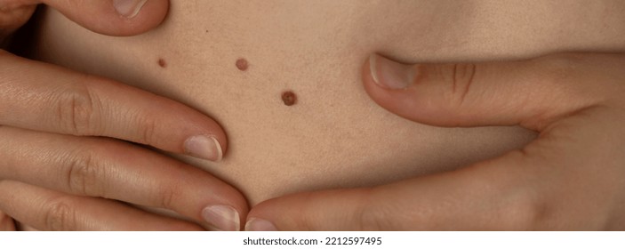 Unrecognizable Woman Showing Her Birthmarks On Skin Close Up Detail Of The Bare Skin Banner Sun Exposure Effect On Skin, Health Effects Of UV Radiation Woman With Birthmarks Pigmentation