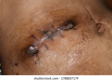Untidy Kocher's incision or subcostal or oblique incision for open cholecystectomy. Infected stitches or wound. It is also done for surgery of liver and biliary tract.