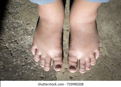 Unusual Swelling Feet While Standing May Be Caused By Inflammation.