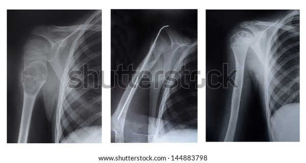 Upper Part Humerus Three Stages Disease Stock Photo 144883798 ...