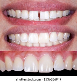 Upper Tooth Filling For Diastema Closure