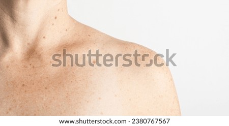 Upper torso of white woman with nevus, moles, spots on the skin, isolated white background. Skin diseases. Insolation. Sun spots. Close up. Cancer. Dermatology. Prevention disease. 