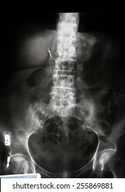 Upright Abdominal X-Ray. Non dilated air-filled loops of small bowel and colon are seen.  An IVC (Inferior Vena Cava) filter is visualized . Degenerative changes in the spine.in this elderly woman. - Shutterstock ID 255869881