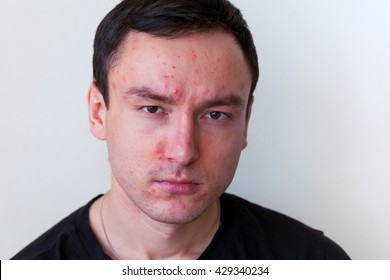 Spotty Face Images, Stock Photos & Vectors | Shutterstock