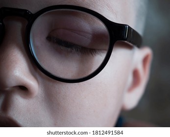 Upset Child Shows His Sick Injured Eye. Boy Was Bitten By Poisonous Midge. Kid Uses Home Remedies For Treatment And Is Going To Doctor For Examination