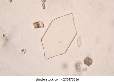 Uric Acid Crystals In Urine.