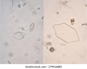 uric acid crystals in urine