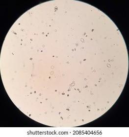 Uric Acid Crystals In Urine Analysis.