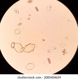 Uric Acid Crystals In Urine Analysis.