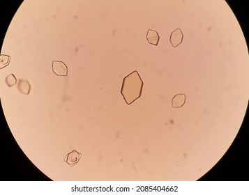 Uric Acid Crystals In Urine Analysis.