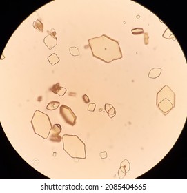 Uric Acid Crystals In Urine Analysis.