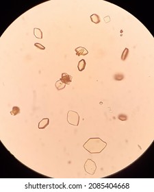 Uric Acid Crystals In Urine Analysis.