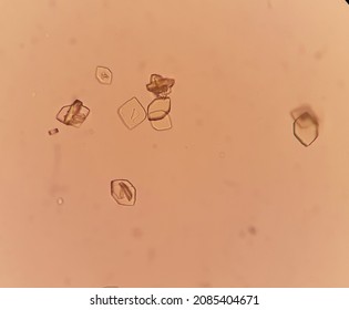 Uric Acid Crystals In Urine Analysis.