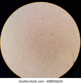 Urinalysis Under 40x Light Microscope Present Red Blood Cells, White Blood Cells Bacteria And Triple Phosphate Crystals.