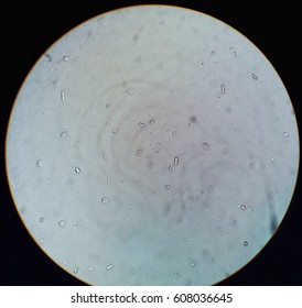 Urinalysis Under 40x Light Microscope Present Red Blood Cells, White Blood Cells Bacteria And Triple Phosphate Crystals.