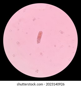 Urinary Sediment Microscopy Is The Presence Of Granular Casts. Casts Are Clusters Of Urinary Sediment Elements Wrapped In A Protein Matrix.