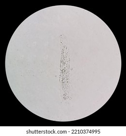 Urinary Sediment Microscopy Is The Presence Of Granular Casts. Casts Are Clusters Of Urinary Sediment Elements Wrapped In A Protein Matrix.