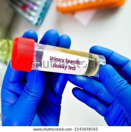 Urinary specific gravity test in laboratory, closeup.