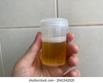 Urine collection in plastic bottle for medical laboratory exam, held by hand.