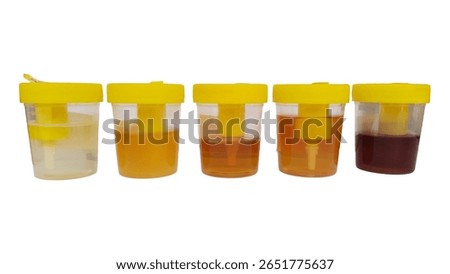 Urine colour, different samples in urine containers in the laboratory, urine, bloody, cup, cystitis, hematuria,Blood in urine (hematuria) ,included urinary tract infection, kidney infection, bladder  