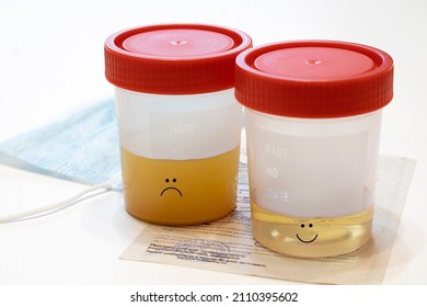 Urine container and direction, good and bad urinalysis. Disposable container for taking biomaterial